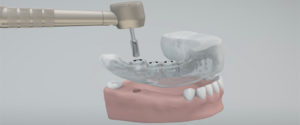 impianti dentali roma
