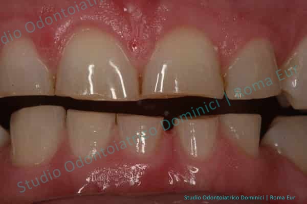 gnatologia denti consumati