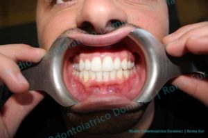 Invisalign ortodonzia invisibile