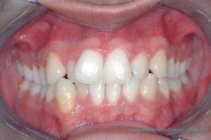 Invisalign ortodonzia invisibile