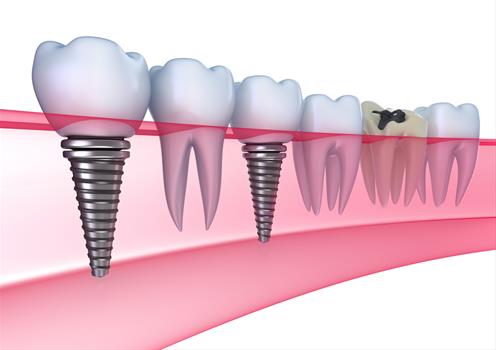 impianti dentali roma offerta